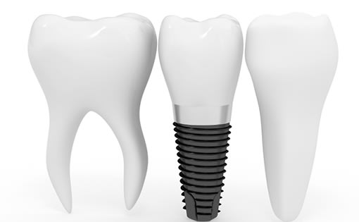 Dental Implants, Cobourg Dentist